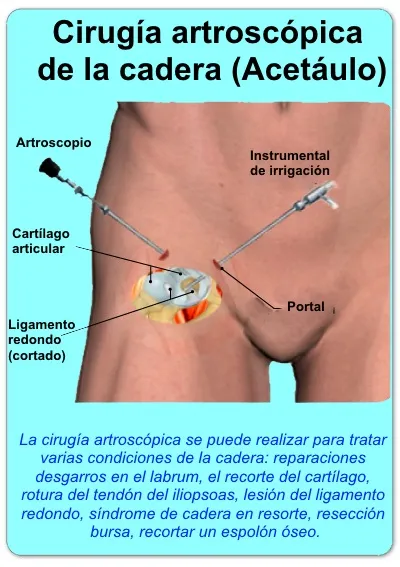 Cirugía de cadera en resorte interna