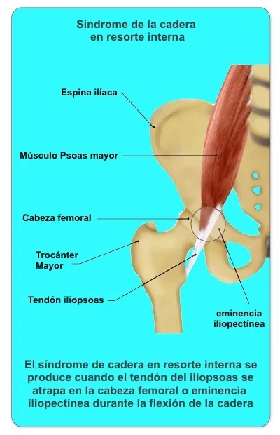 Músculo psoas ilíaco