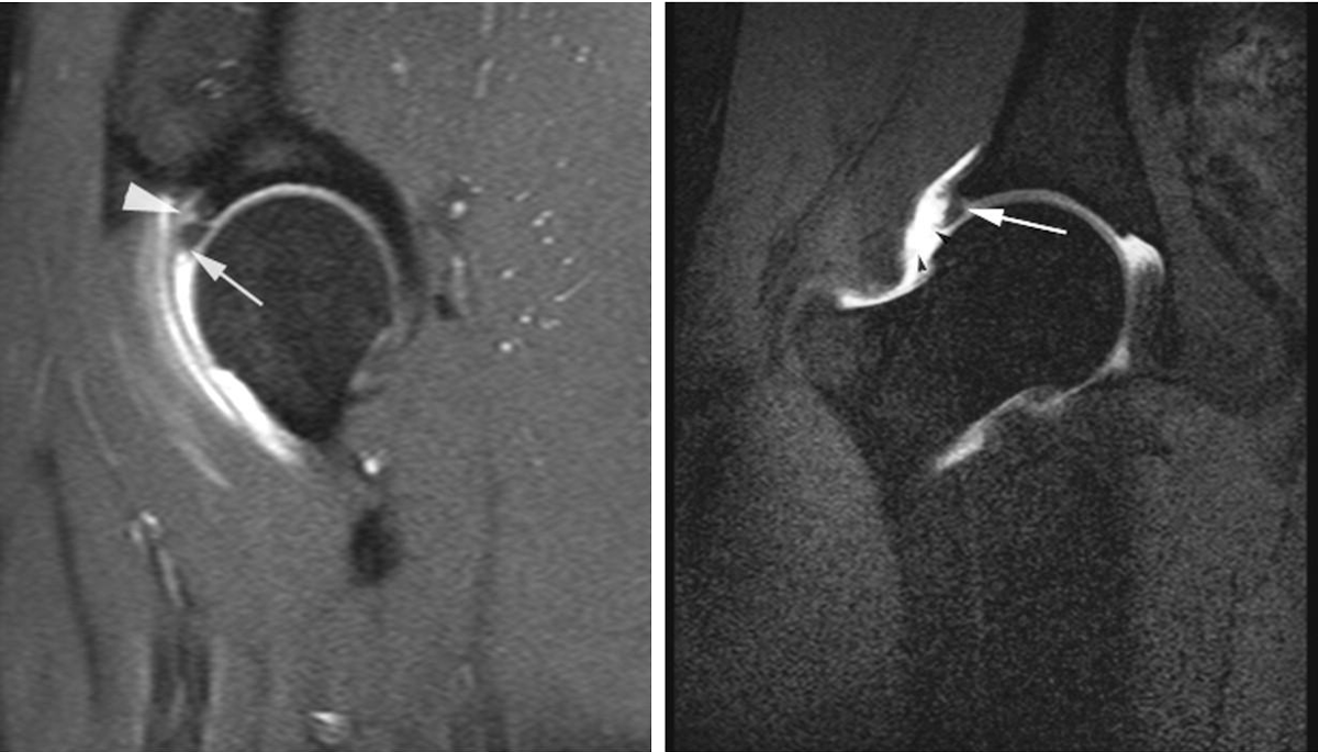 Artro resonancia en lesión del labrum y pinzamiento femoroacetabular