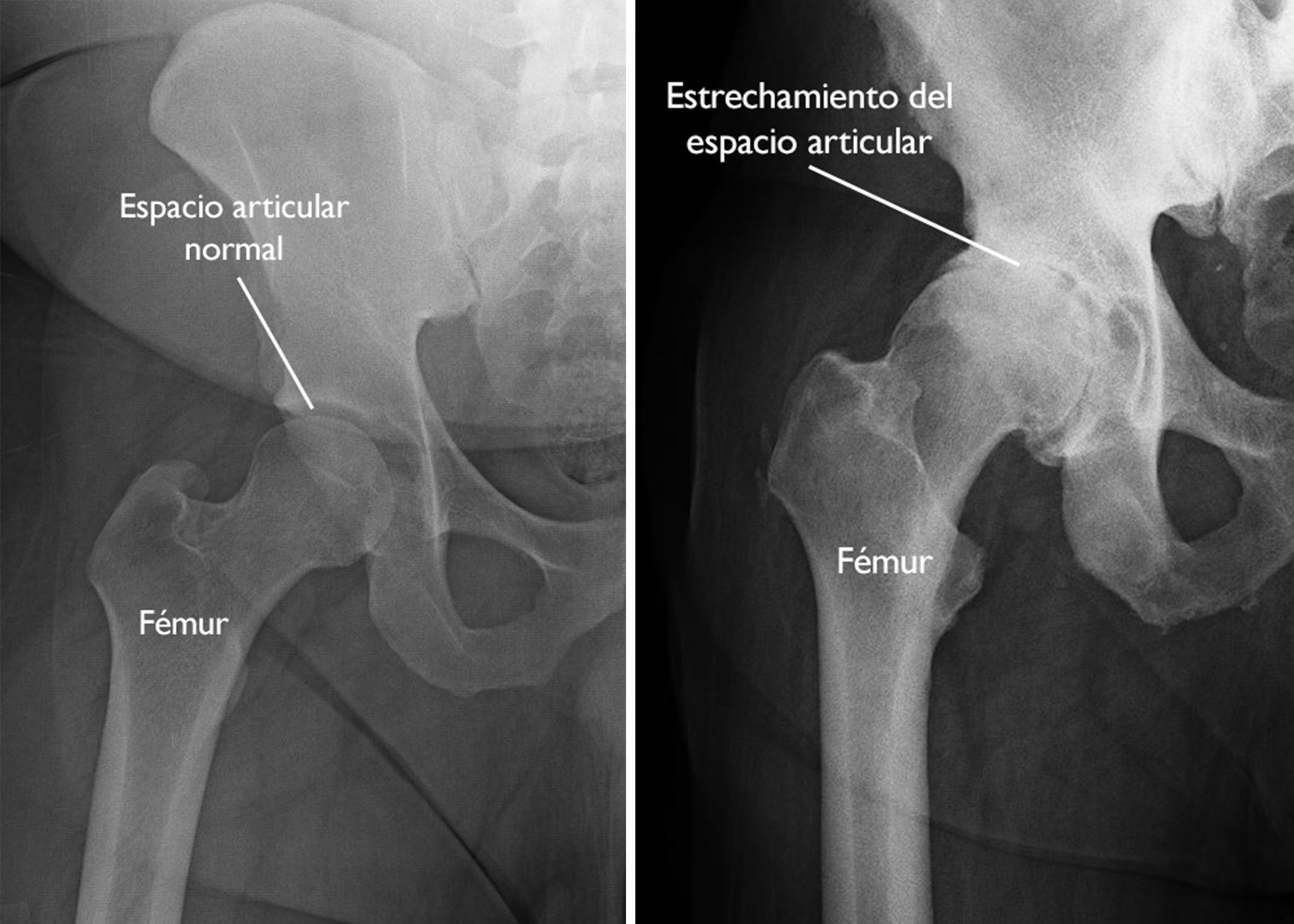 Radiografia de artrosis de cadera