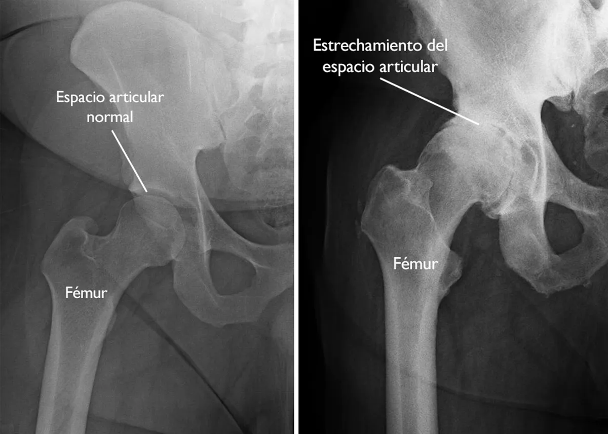 Radiografía de artrosis de cadera