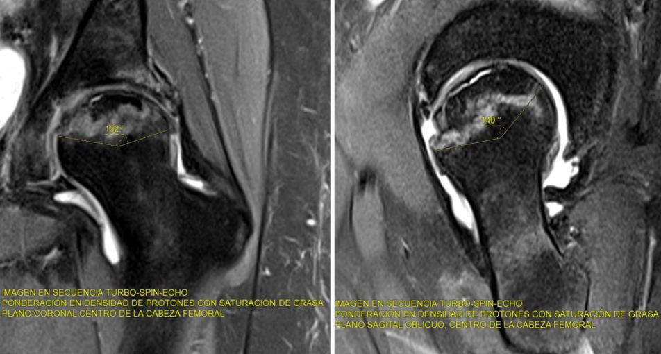 RM de necrosis avascular de cabeza femoral