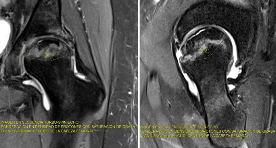 Resonancia magnética en necrosis avascular de la cabeza femoral