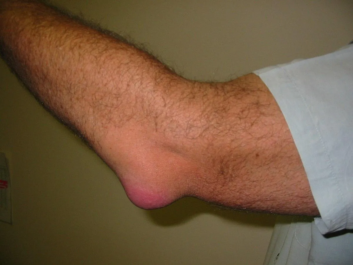 Imagen de bursitis olecraniana