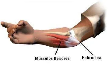 Ilustración de epitrocleitis 1