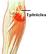 Ilustración de epitrocleitis 2