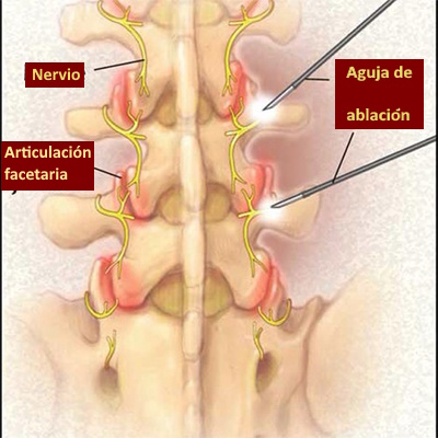 Técnicas de ablación nerviosa lumbar