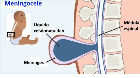 Esquema de meningocele