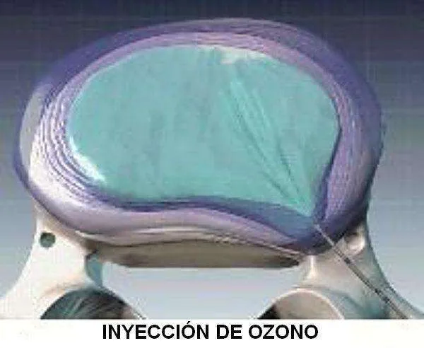 Inyección intradiscal