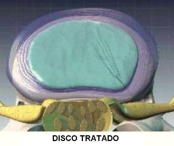 Disco tratado mediante nucleólisis