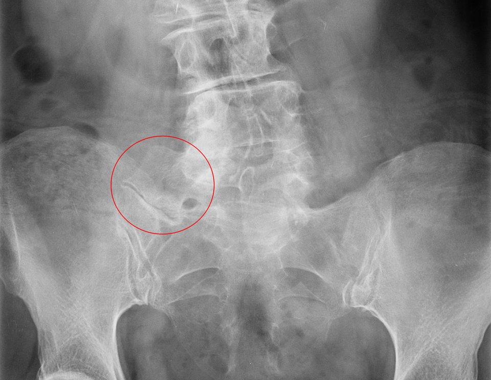 Radiografía lumbar con síndrome de Bertolotti