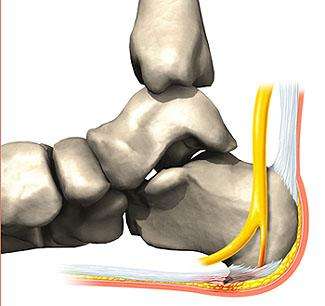 Espolón calcáneo posterior