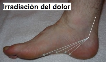 Distribución del dolor en el síndrome del túnel tarsiano