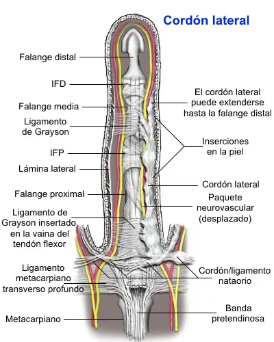 Cuerda lateral en enfermedad de Dupuytren