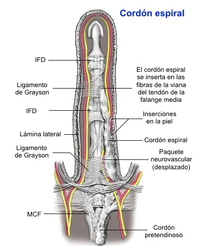 Cuerda en espiral en enfermedad de Dupuytren