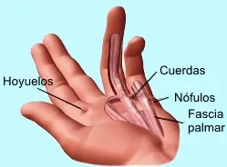 Nódulo en la palma por enfermedad de Dupuytren