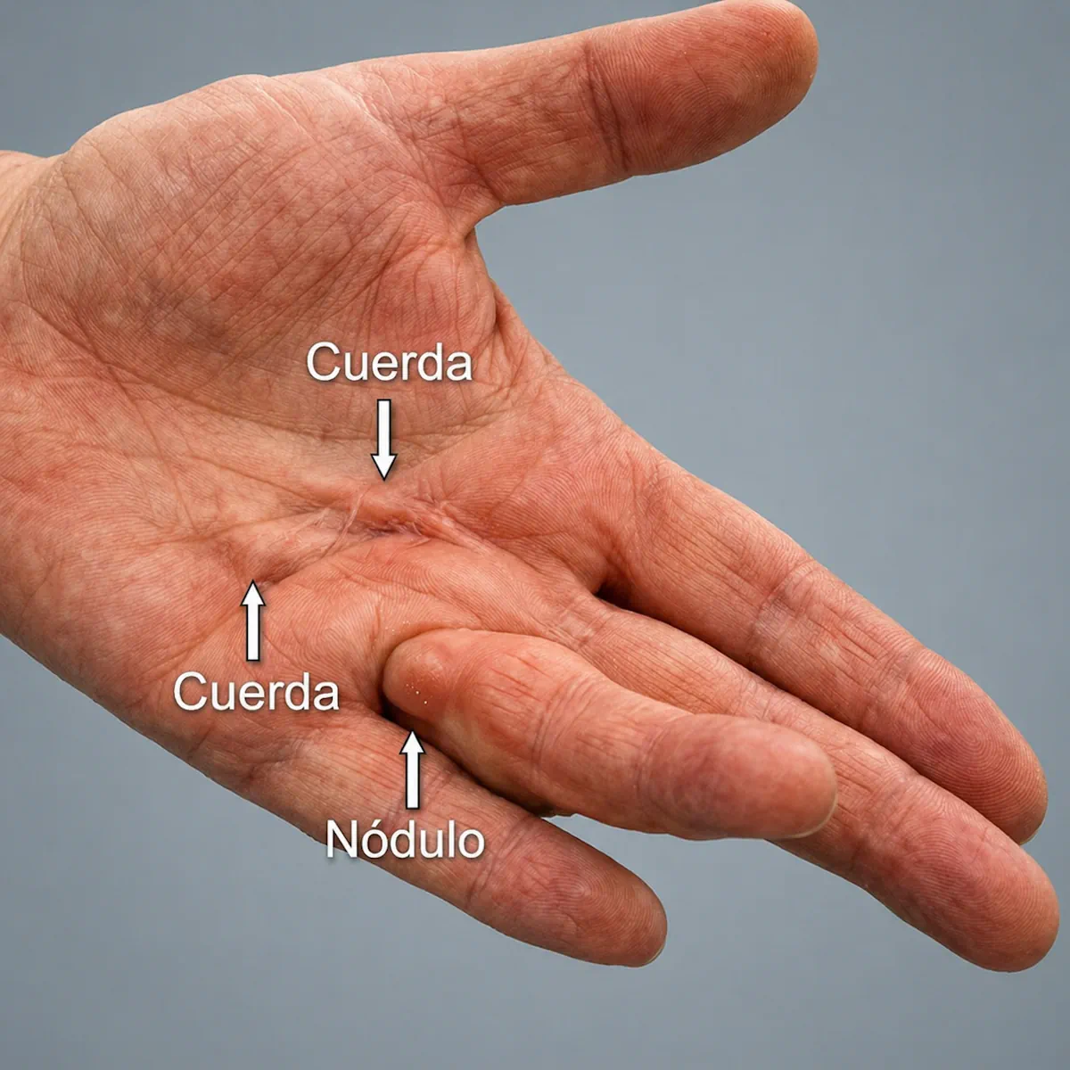 Nódulo adherido a la piel en Dupuytren