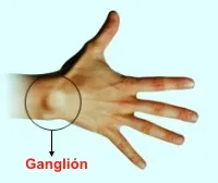 Tumefacción por ganglión en la mano