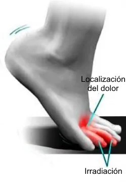 Localización del dolor en el neuroma de Morton