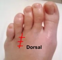 Cirugía dorsal en neuroma de Morton