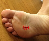 Abordaje plantar