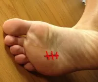Abordaje plantar en neuroma de Morton