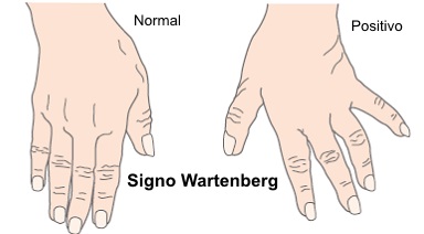 Signo de Wartenberg