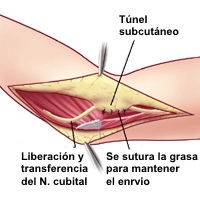 Transposición anterior