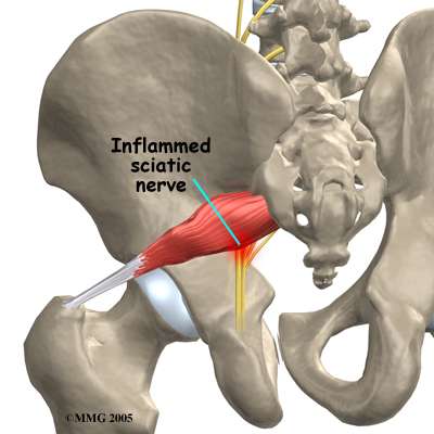 Right sacroiliac joint steroid injection