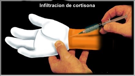 Carpal tunnel steroid injection technique