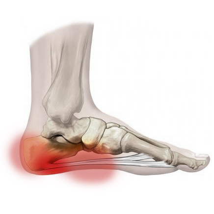 Introducción fascitis plantar