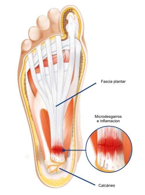 Degeneración fascial