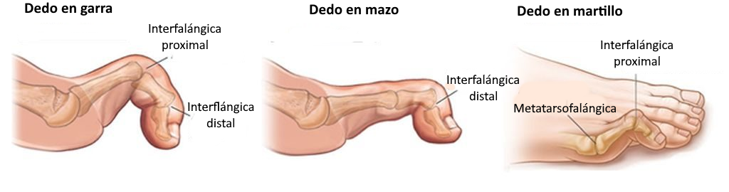 Dedos en garra, martillo y mazo