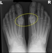 Radiografía hallux rigidus