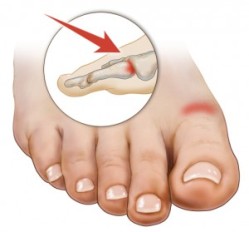Hallux rígidus