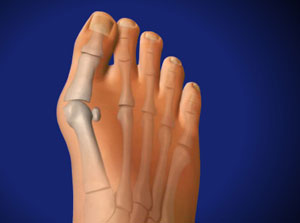 Hallux valgus