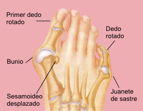 Inspección de hallux valgus