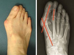 Radiografía de hallux valgus