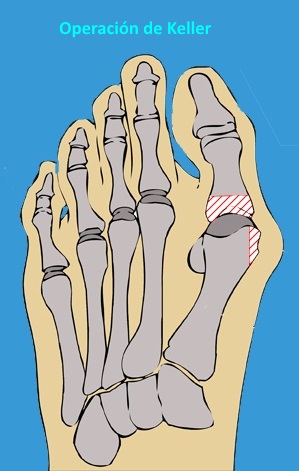 Cirugía hallux valgus