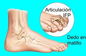 Dedo en martillo lateral