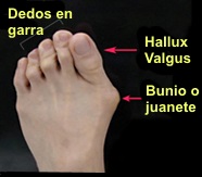 Hallux valgus complex