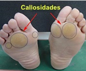 Hiperqueratosis y bursitis