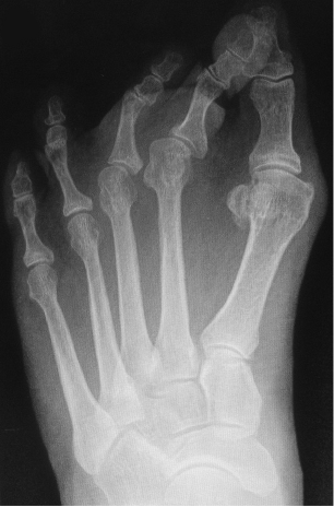 Radiografía de placa plantar
