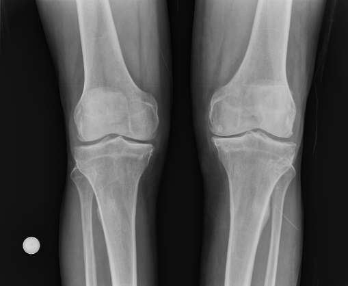 radiografía de una Rodilla con artosis