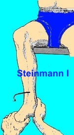 Signo de Steinmann I