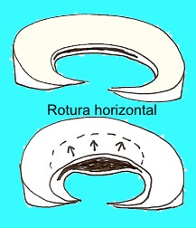 Rotura horizontal degenerativa