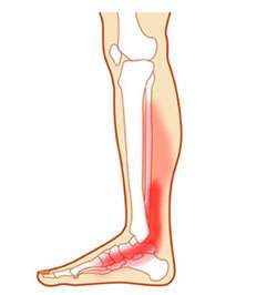 Tumefacción medial tibial posterior
