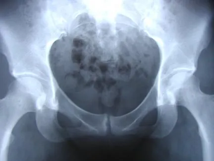 Radiografía de pubis