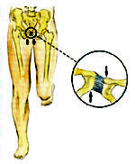 Carrera de velocidad y pubalgia