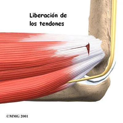 Cirugía de epitrocleitis 1
